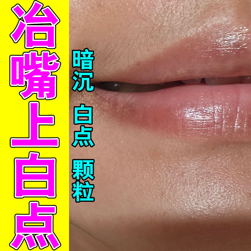 皮脂腺异位嘴唇长小白点疙瘩脂肪颗粒嘴巴疙瘩起皮红肿软膏