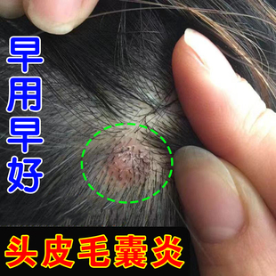 头上长痘痘头皮毛囊炎专用头皮长疙瘩脓包红肿瘙痒脂溢性皮软膏炎