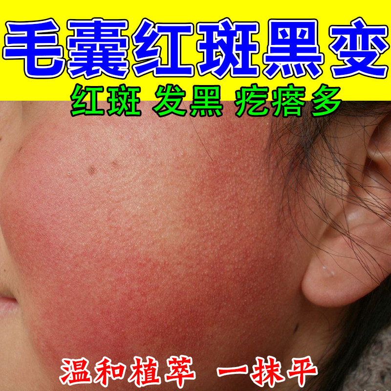 冶脸毛囊红斑黑变角质凸起疙瘩堆积暗沉脸部泛红黑粗糙草本修护膏