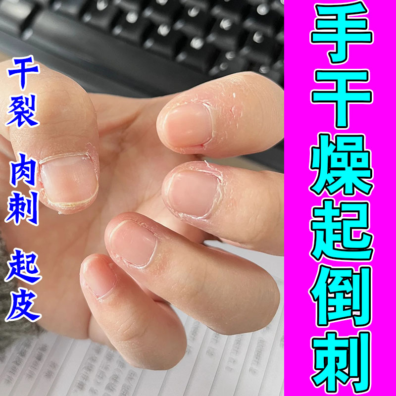 手指倒刺儿童修复护理有肉刺指甲边缘干裂起皮防倒刺保湿草本膏乳