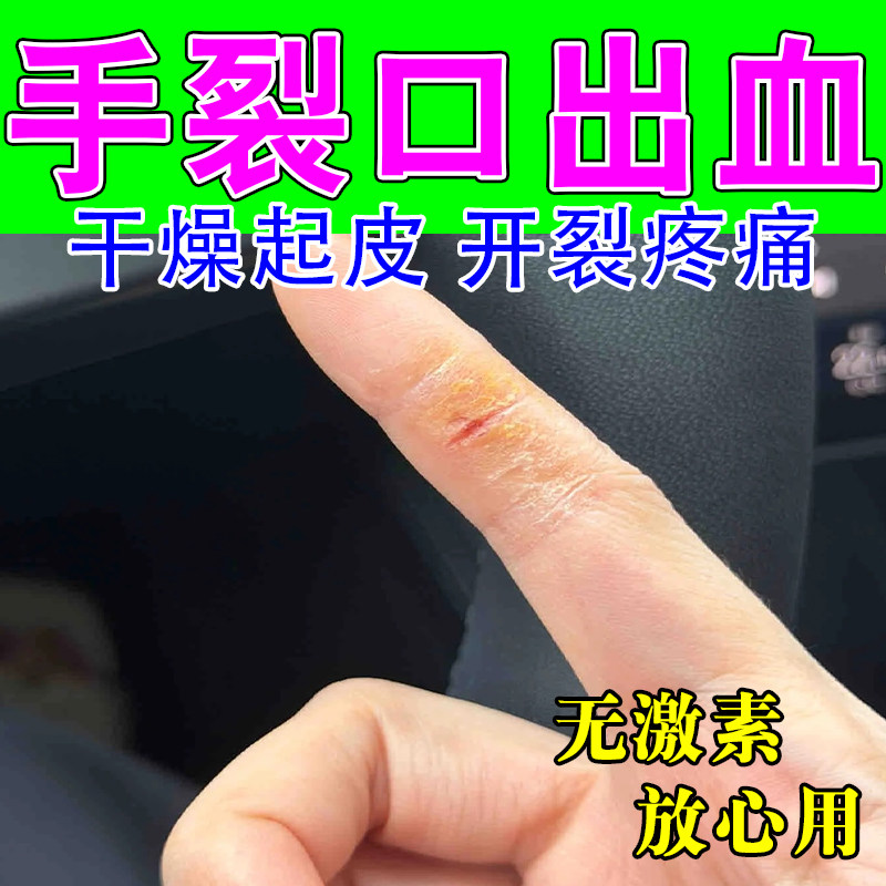 手脱皮干裂粗糙手指头裂口子季节性手干燥起皮掉屑干裂保湿膏