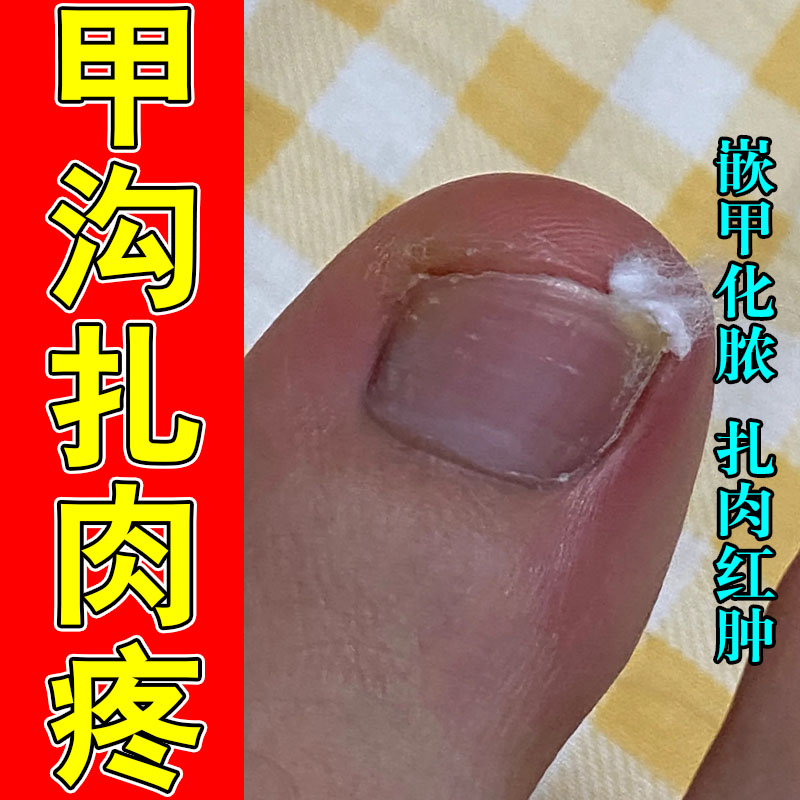 甲沟红肿疼冶发红肿大肿指甲息肉芽改善红肿痛修护指甲乳膏