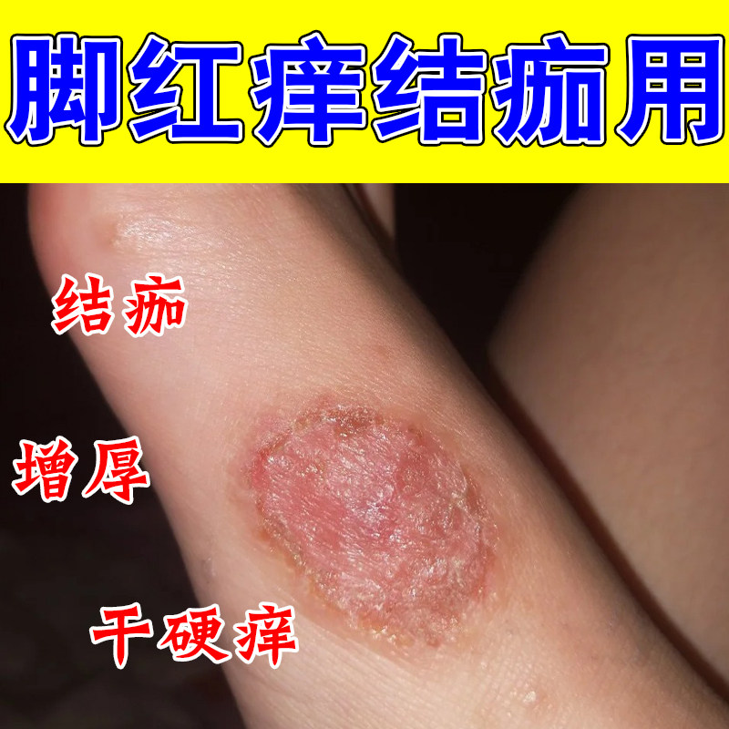冶脚底干红肿痒脚侧痒脚脖子皮肤干燥粗糙痒起皮真菌发痒修护膏