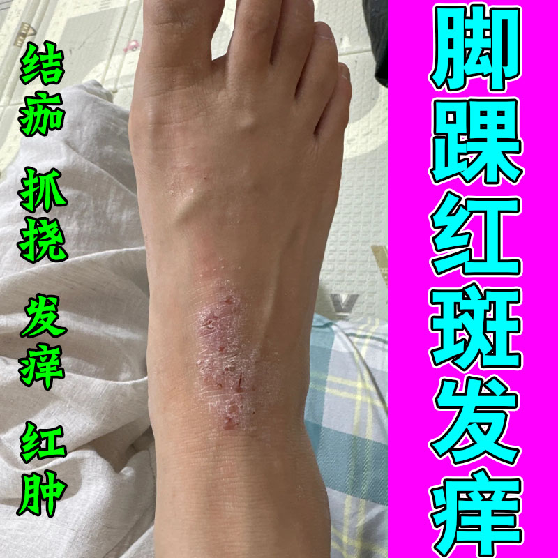 冶脚踝起皮脚脖子痒挠角化型干痒皮肤干燥起皮屑草本修护乳膏