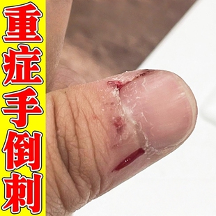 指甲边缘去死皮手指倒刺营养油修复神器软化剂防倒刺痛脱皮干裂霜