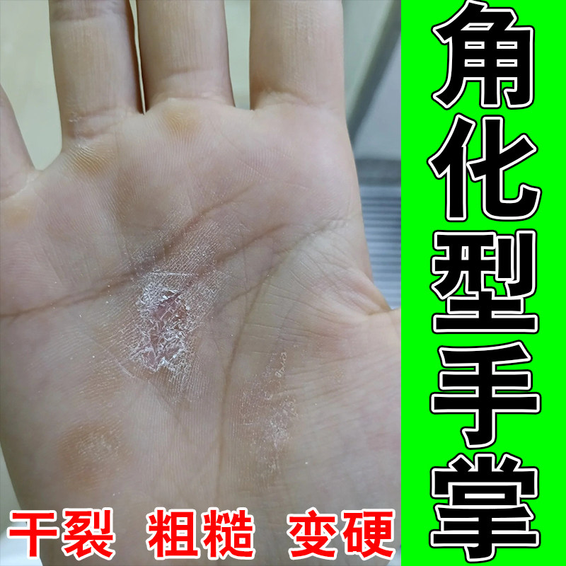 角化型手部干燥粗糙起皮开干裂口角质增厚掉皮厚修护膏乳