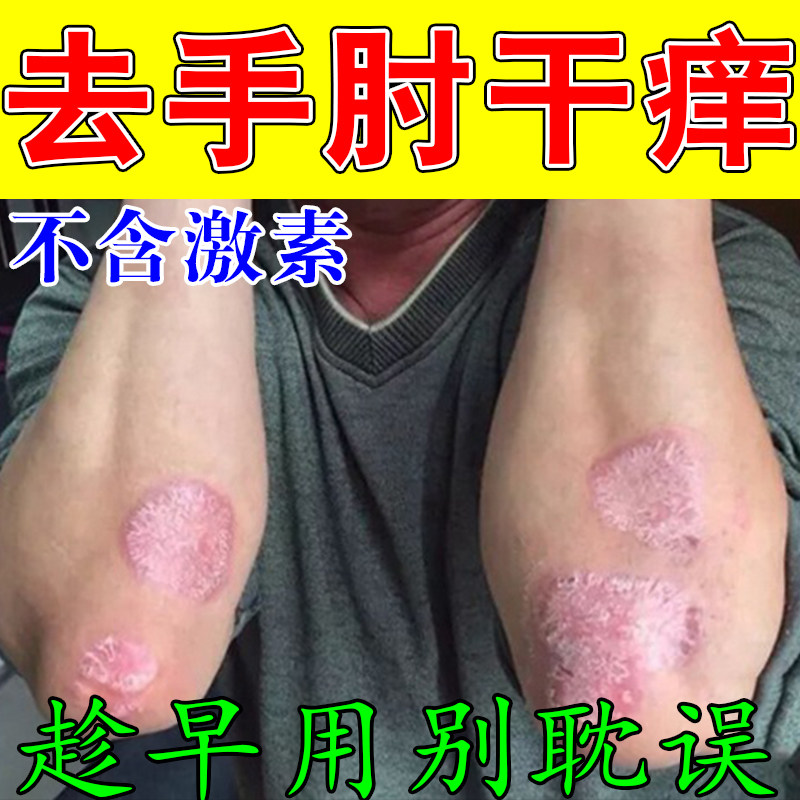 手肘红屑皮肤药胳膊肘长疙瘩起红疙瘩肤红痒神经干燥脱屑保湿乳膏