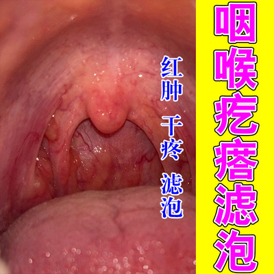 舌壁淋巴滤泡增生喉咙灼热异物感草本润喉养护喷剂