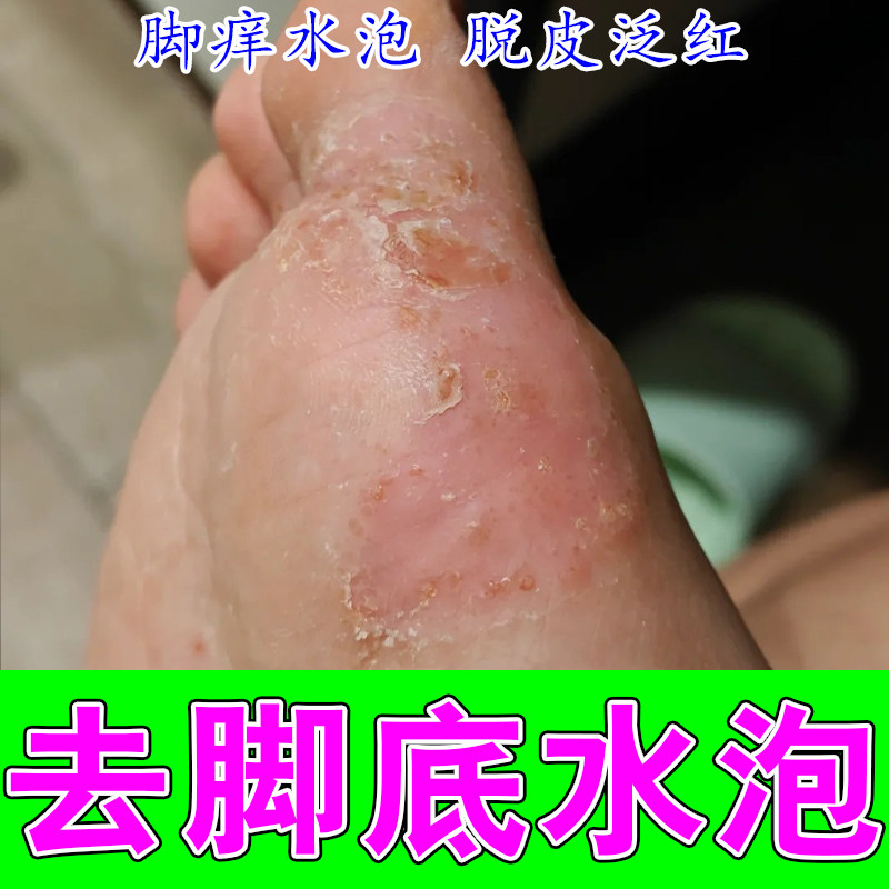 脚起泡发痒疙瘩起皮干燥粗糙角质增厚反复起皮发红修护保湿软膏