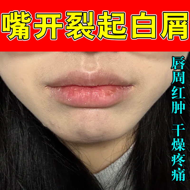 口周皮唇嘴唇周围一圈红斑干裂脱皮嘴巴过敏起皮嘴角上火疼