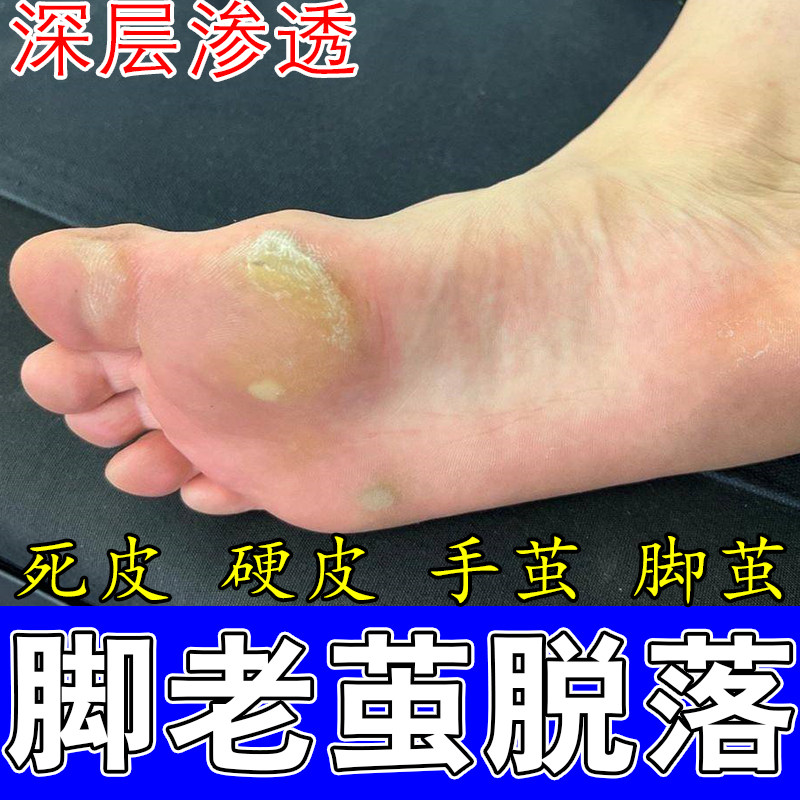 脚上长茧子老茧软化干活脚掌心磨出厚茧硬疙瘩角质增厚软化贴