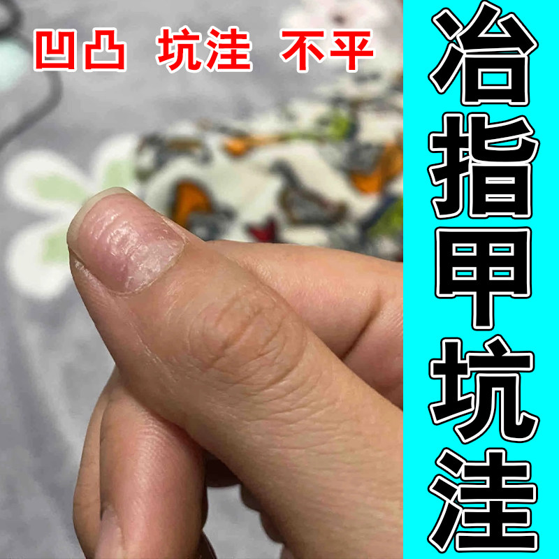 指甲竖纹甲床分离空甲开裂受损分层凹凸不平调理修复液