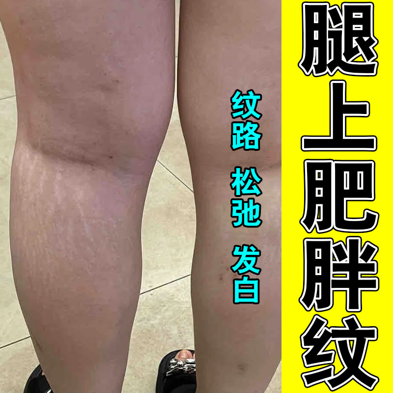 改善生长纹淡化大腿学生男淡化纹路淡肥胖纹修复膏