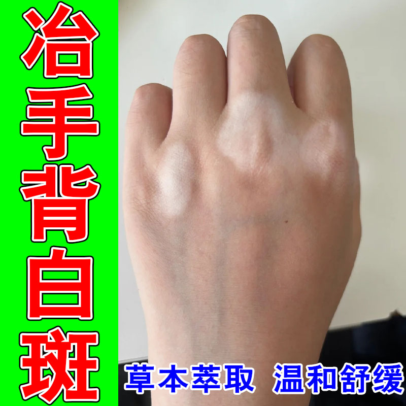 改善手背长白斑外用修复促进黑色素生长补骨脂草本萃取膏乳