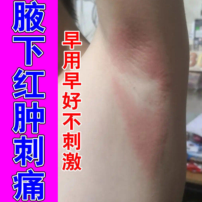 腋窝红肿疼痛痒防摩擦淹红腋下异味出汗淹红草本修护温和膏