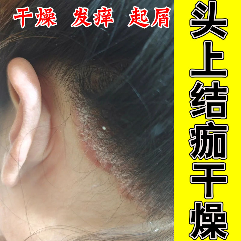 头发起屑发痒红肿结痂头皮大片鳞屑干燥粗糙不适养护膏
