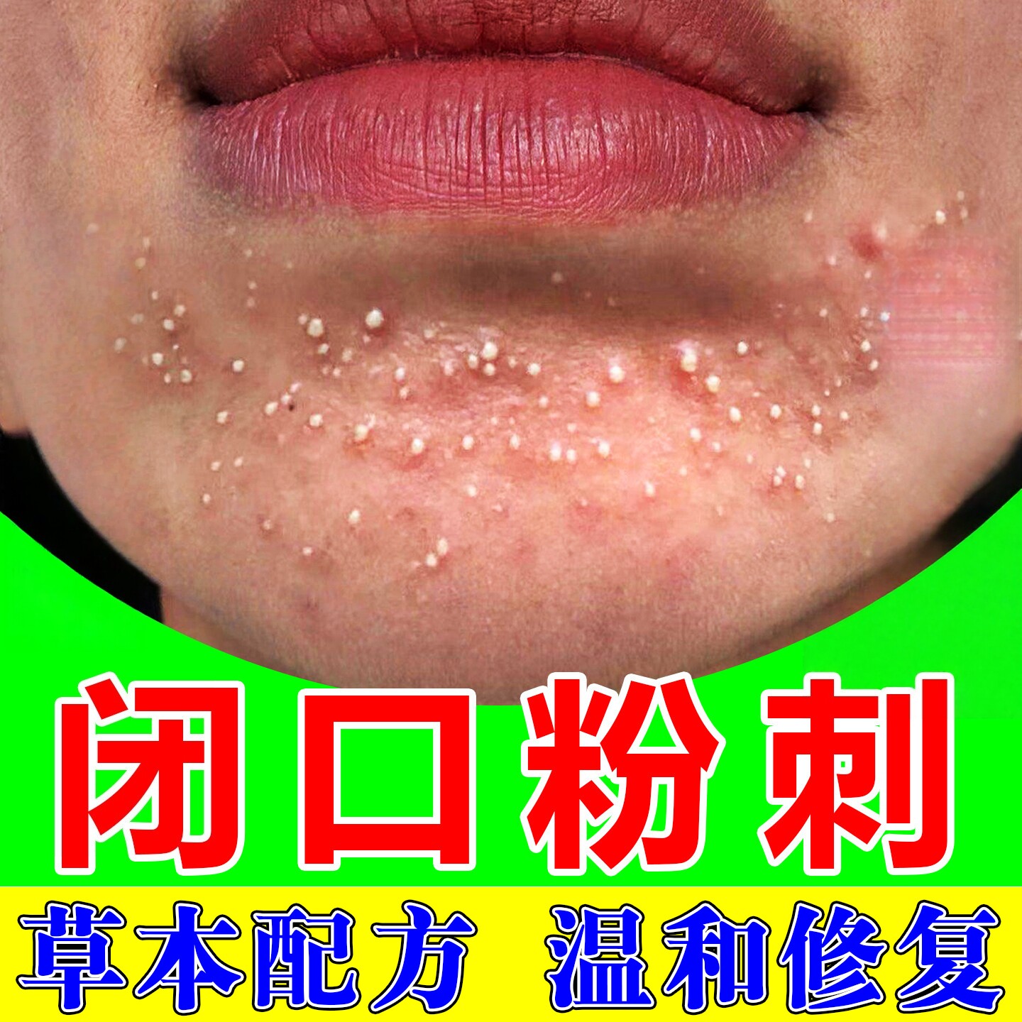 去闭口粉刺的克下巴反复长痘脸部额头痘脸上小疙瘩长痘专用乳膏