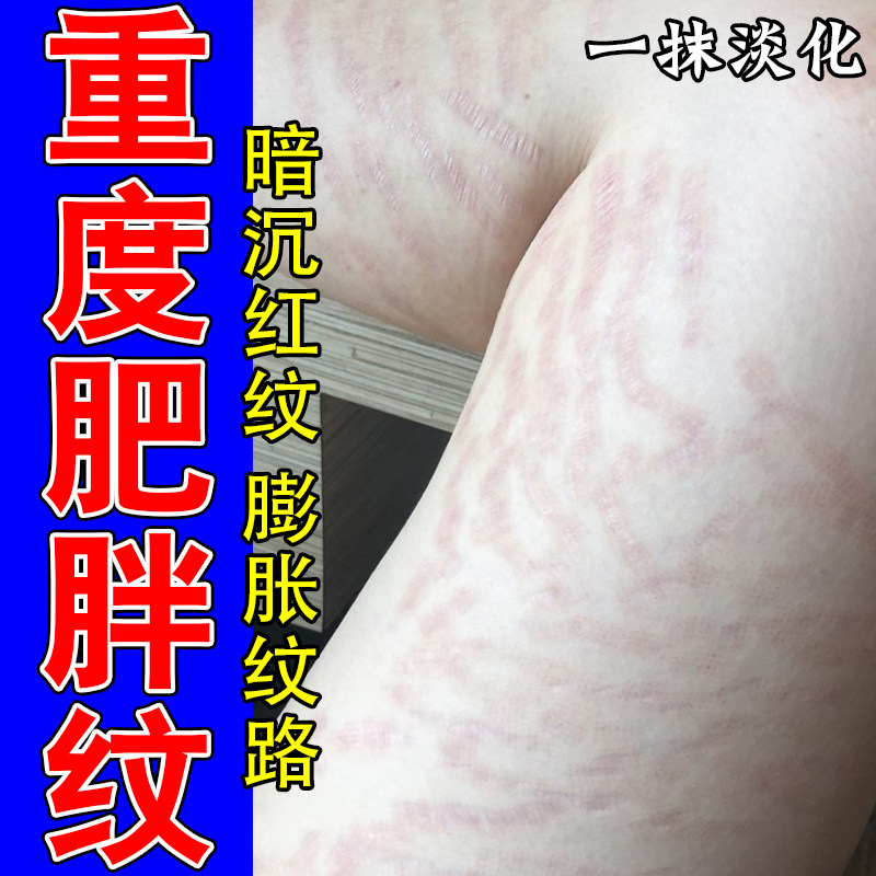 去肥胖纹修复膏去学生生长纹淡化大腿内侧青少年专用淡化去肥胖纹