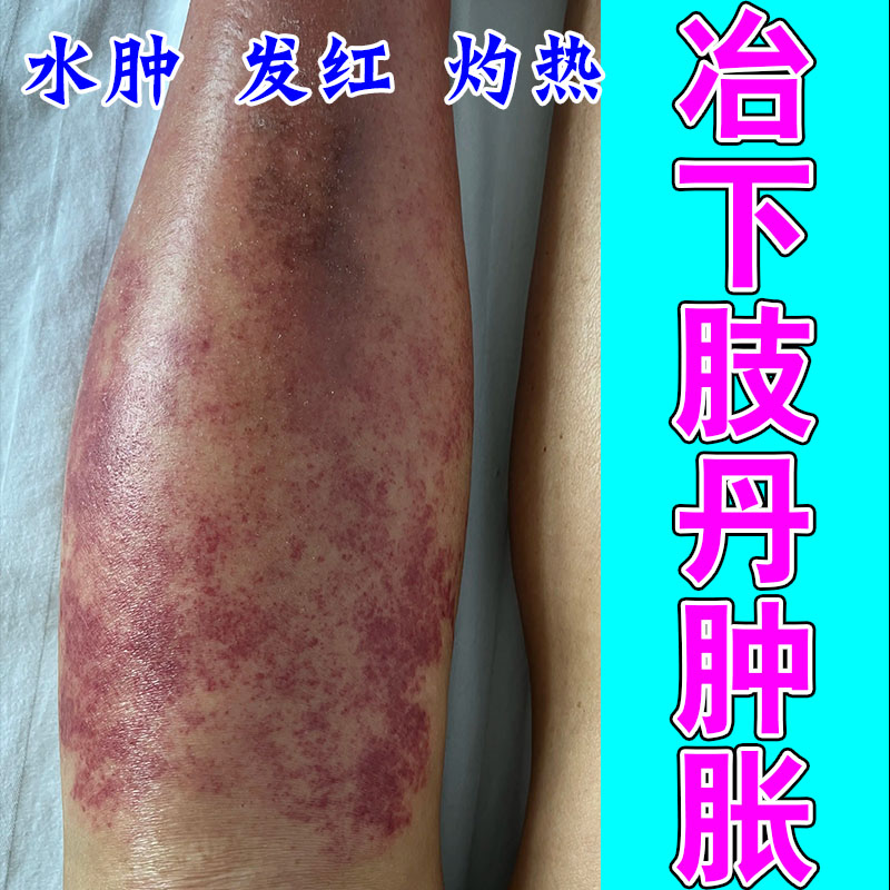 腿脚流火肌肤灼热肿痛小腿发红发痒草本温和修护软膏