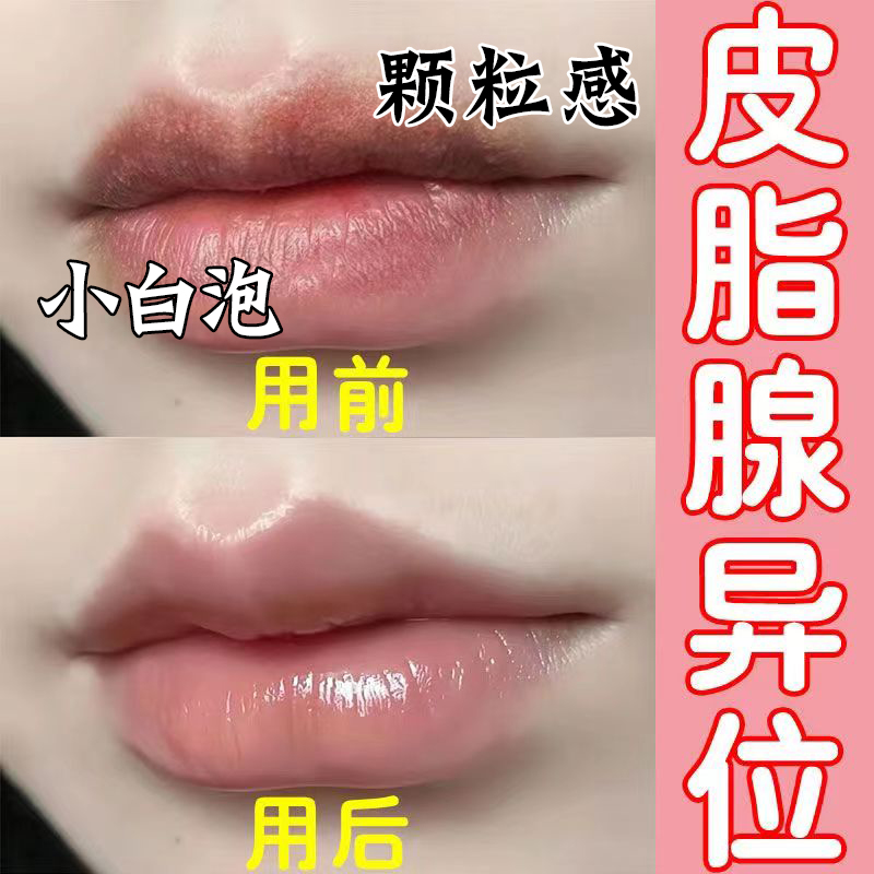 皮脂腺异位嘴唇白点小颗粒润唇膏
