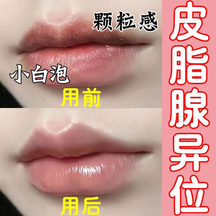 皮脂腺异位嘴唇干裂起泡润唇膏唇部长脂肪粒小白点嘴巴暗沉脱皮