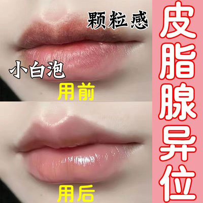 皮脂腺异位嘴唇白点小颗粒润唇膏