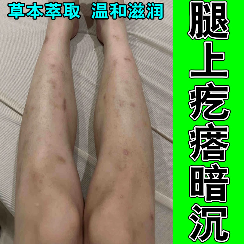 皮肤蚊虫抓挠暗沉黑斑深色黑印肌肤修护积雪草舒缓按摩膏