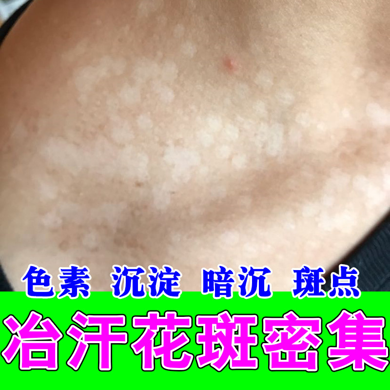 汗斑花斑用乳膏汗斑净去花斑深斑腋下前胸背部片状草本修护膏