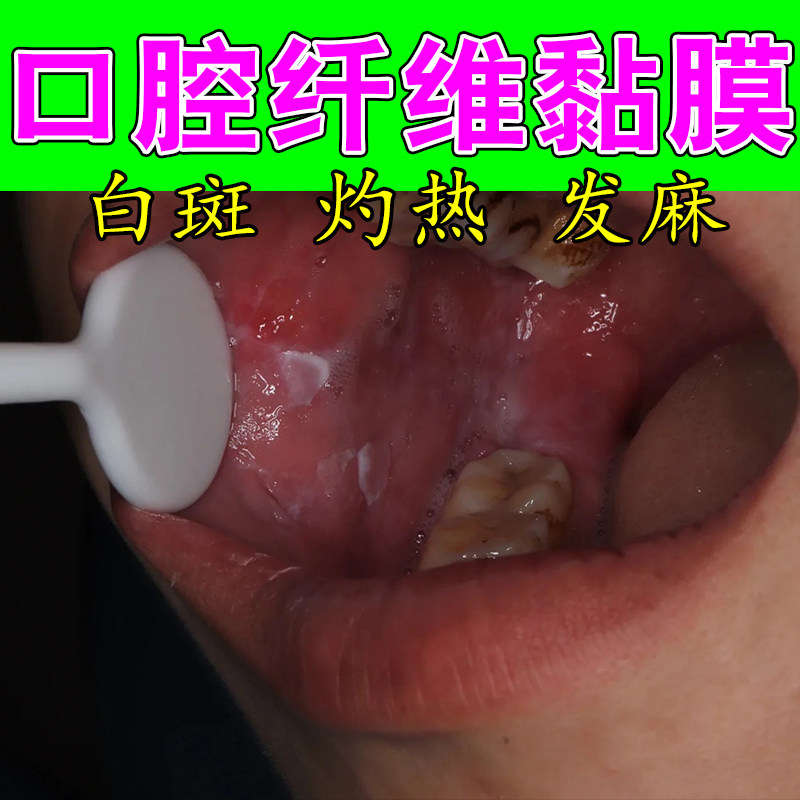口腔表层黏膜白斑修护纤维化严重黏膜不适口腔护理草本喷剂