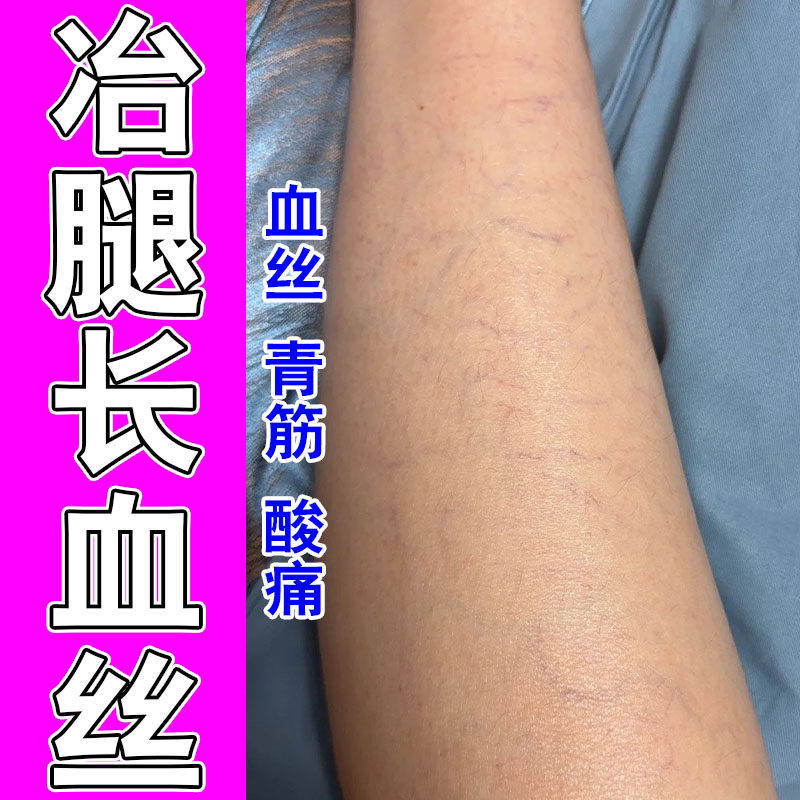 小腿红血丝外露改善毛细血管扩张缓解腿部胀痛草本萃取修护软膏