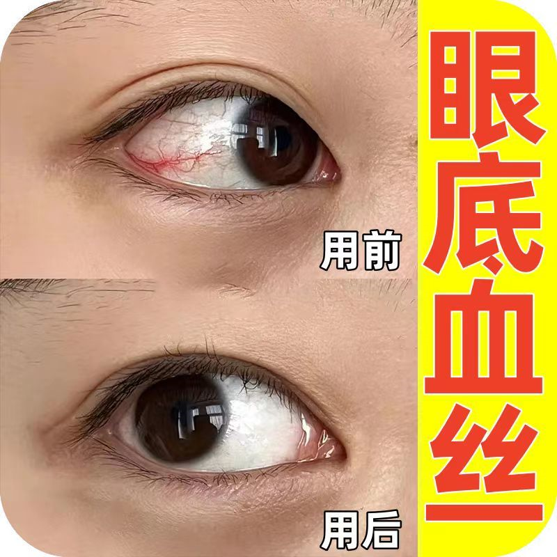 快速去红血丝眼睛红血丝滴眼液充血干涩眼部酸胀防疲劳眼红正品