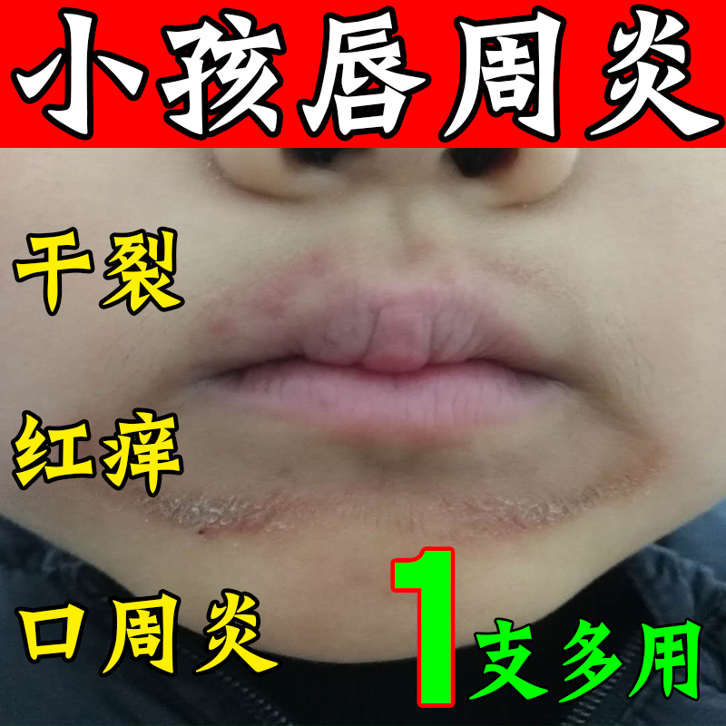 小孩舔嘴巴嘴唇一圈红口周炎唇膏