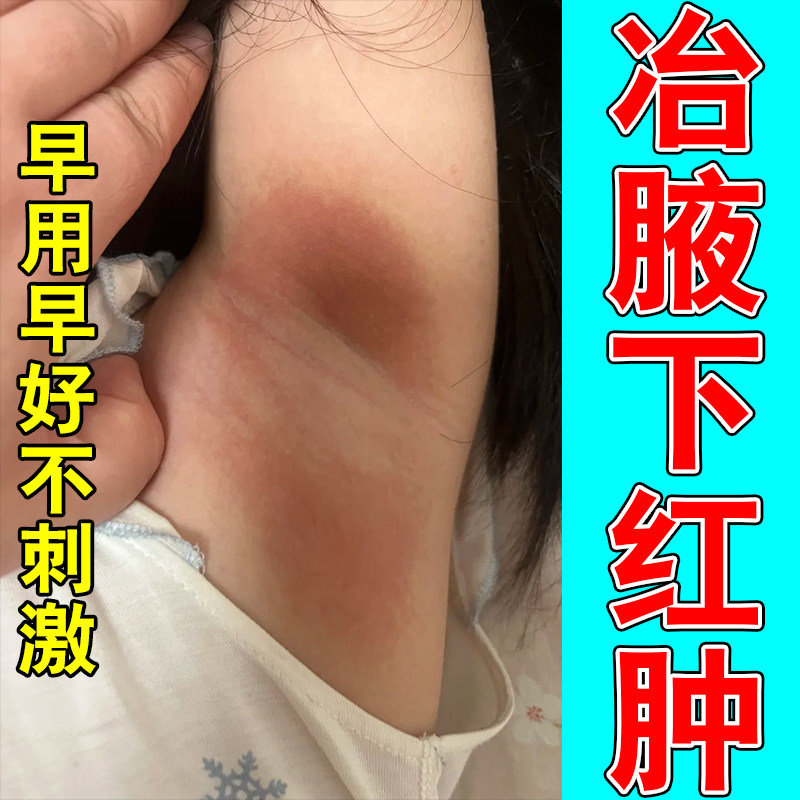 腋窝红肿疼痛痒防摩擦淹红腋下异味出汗淹红草本修护温和膏