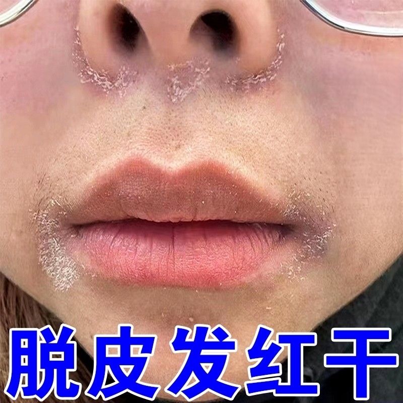 鼻子两侧发红脱皮鼻翼两边嘴角泛红干燥起皮瘙痒掉皮修复专用药膏
