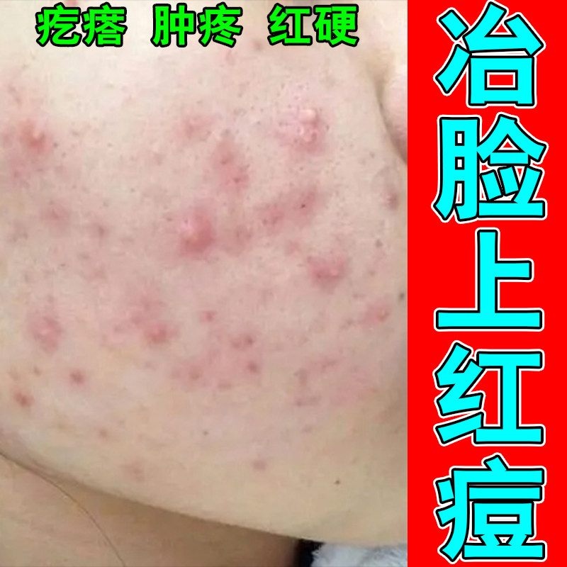 脸部干痒起皮红肿硬块粉刺青春痘疙瘩粉刺植物萃取保湿乳霜