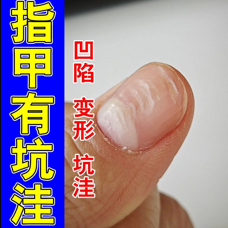 指甲竖纹冶甲面受损开裂指甲凹凸不平甲肉分离增厚草本修复液
