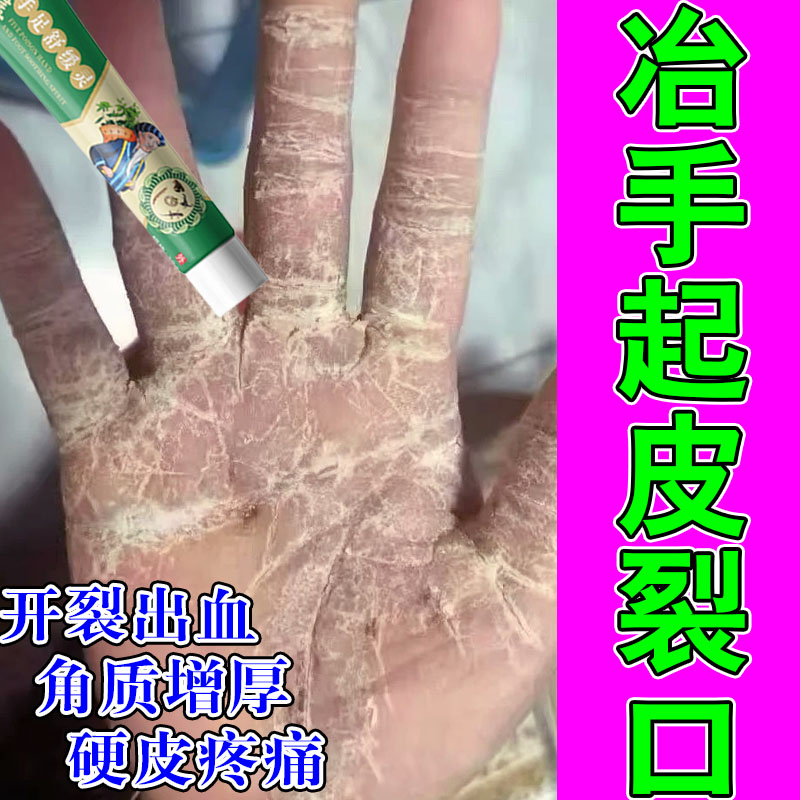 手指干裂发硬粗糙痒真菌手指头脱皮干裂长硬疙瘩手气修护软膏