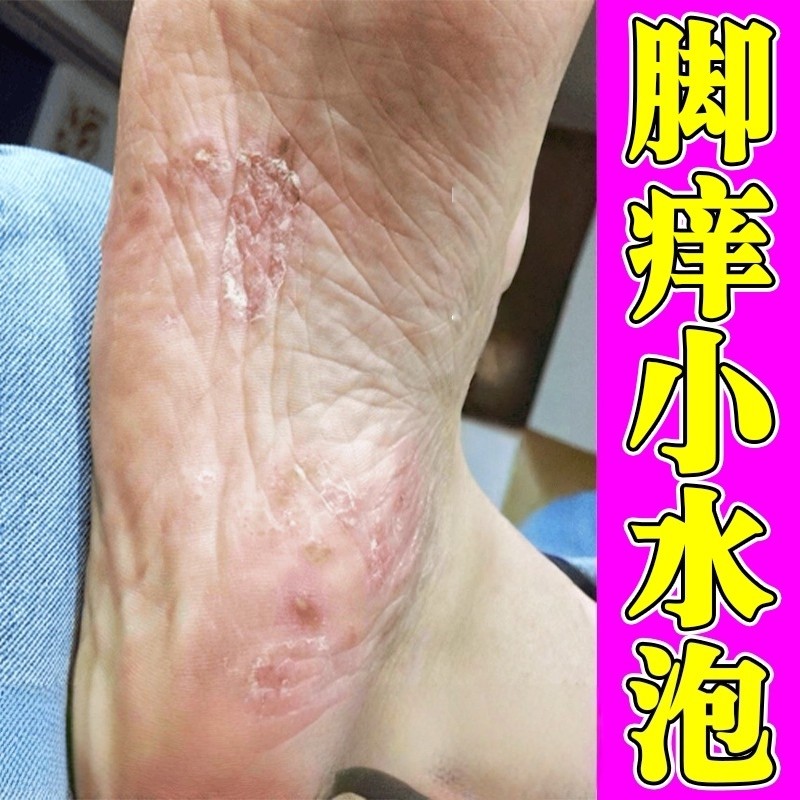 脚痒起水泡脚掌脱皮烂脚丫止痒真菌感染水疱糜烂脚底长小红点软膏,保健用品,皮肤消毒护理（消）,淘宝优惠券,粉丝福利购,淘宝优惠卷