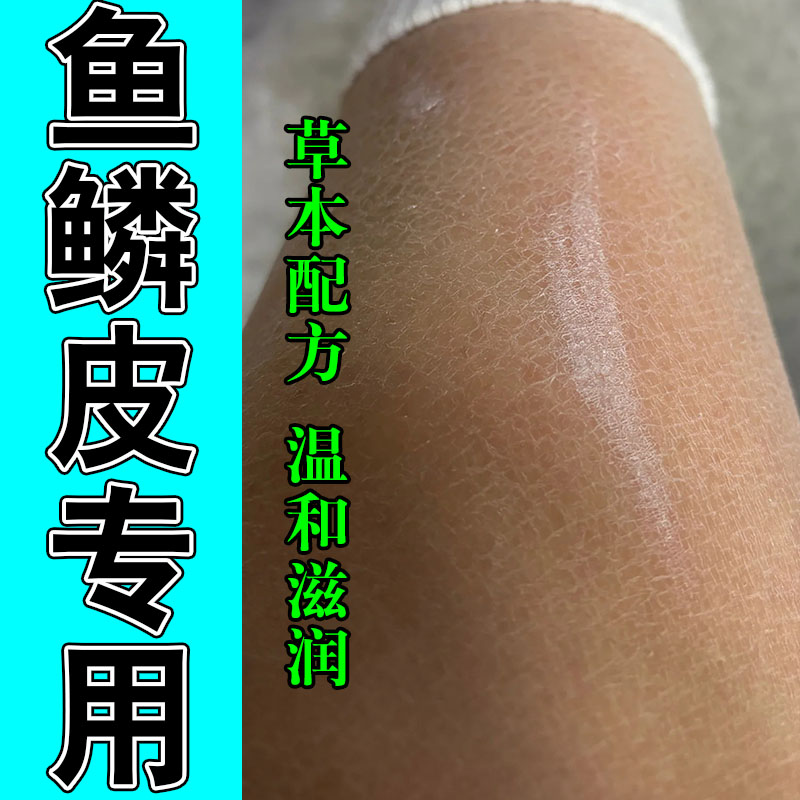改善鱼鳞皮肤干燥起皮腿上起白屑干裂粗糙全身修护保湿补水甘油
