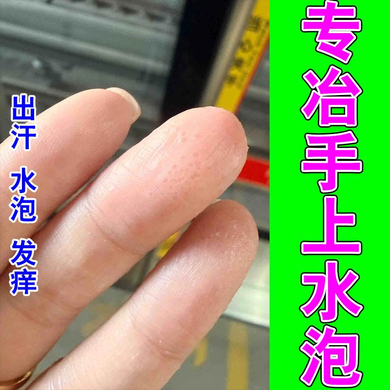 冶手指透明水泡小颗粒疙瘩手出汗多发痒起皮干燥保湿修护膏