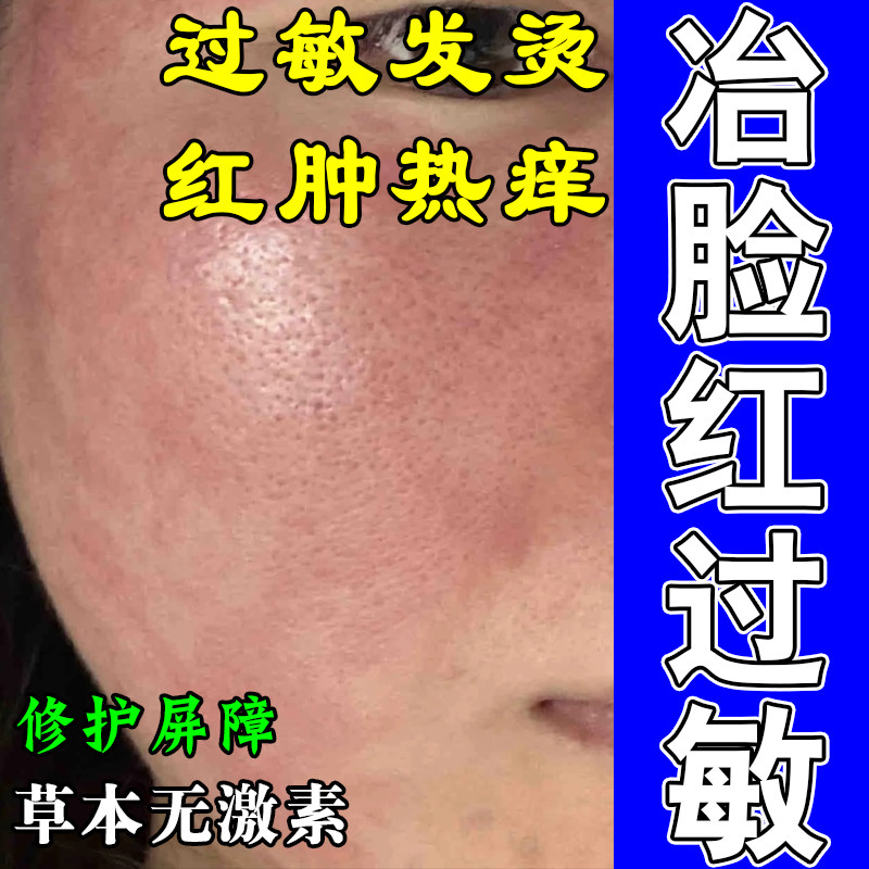 脸蛋敏感泛红发痒灼热起皮换季不适干疼植萃精华舒缓修护膏