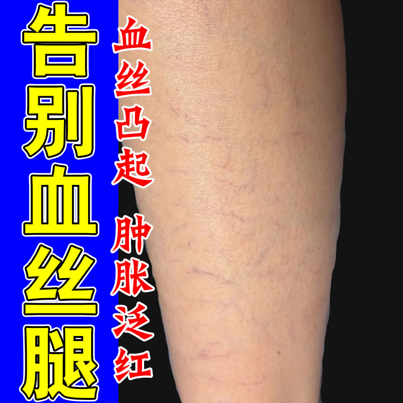 冶腿上有红血丝血管扩张修复红血丝血管堵塞扩张酸痛专用草本乳霜