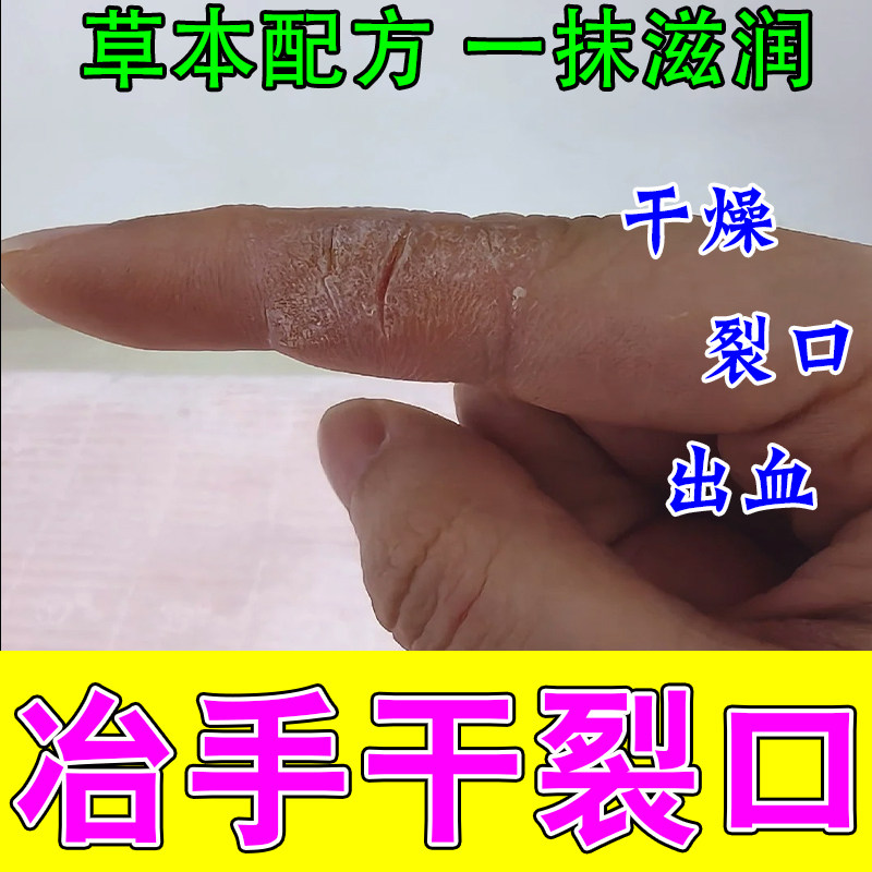 手指干裂蜕皮手指头裂口子冶手掌干燥粗糙脱皮植物萃取保湿乳膏