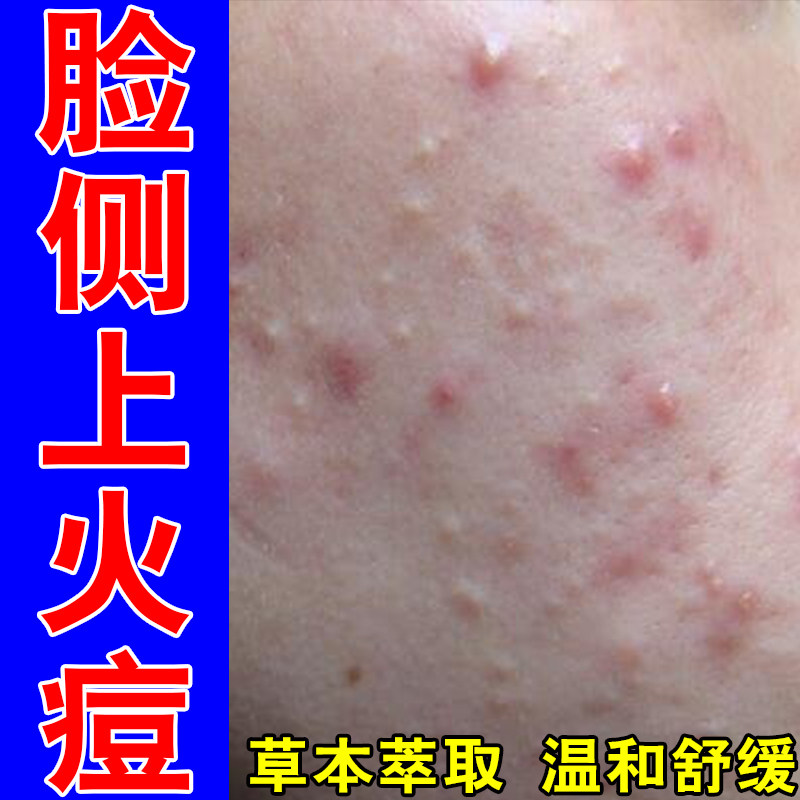 冶脸上红肿硬块起皮干燥成人粉刺疙瘩修护草本保湿乳霜