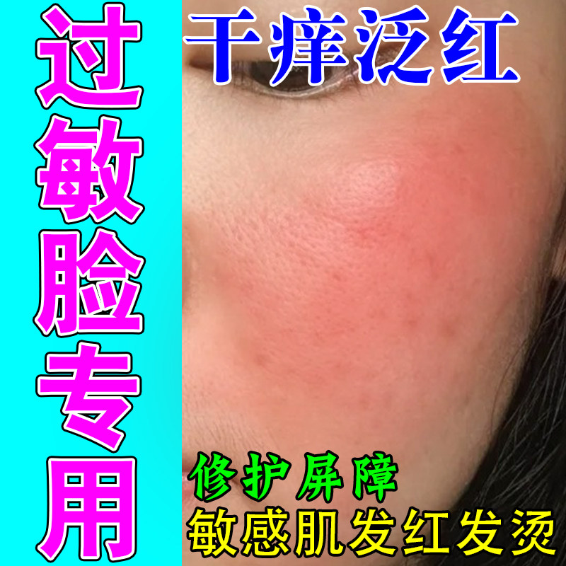 脸部肌肤发红干痒红肿刺痛脱屑敏感灼热植物萃取保湿膏