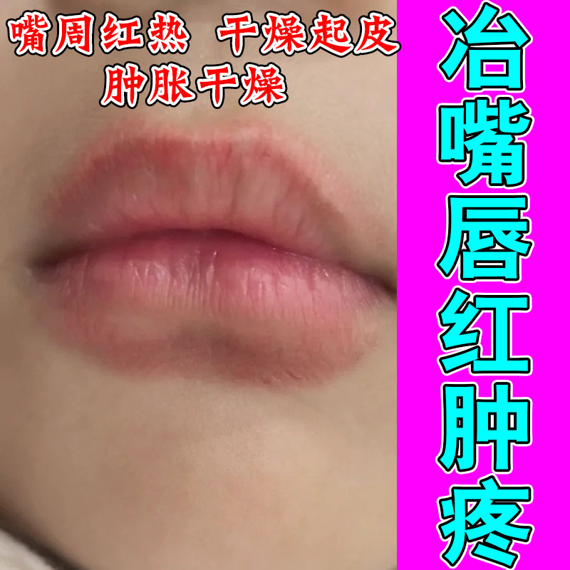 唇角嘴唇干裂脱皮唇乳膏修护唇口角起皮干燥红肿用润唇膏乳