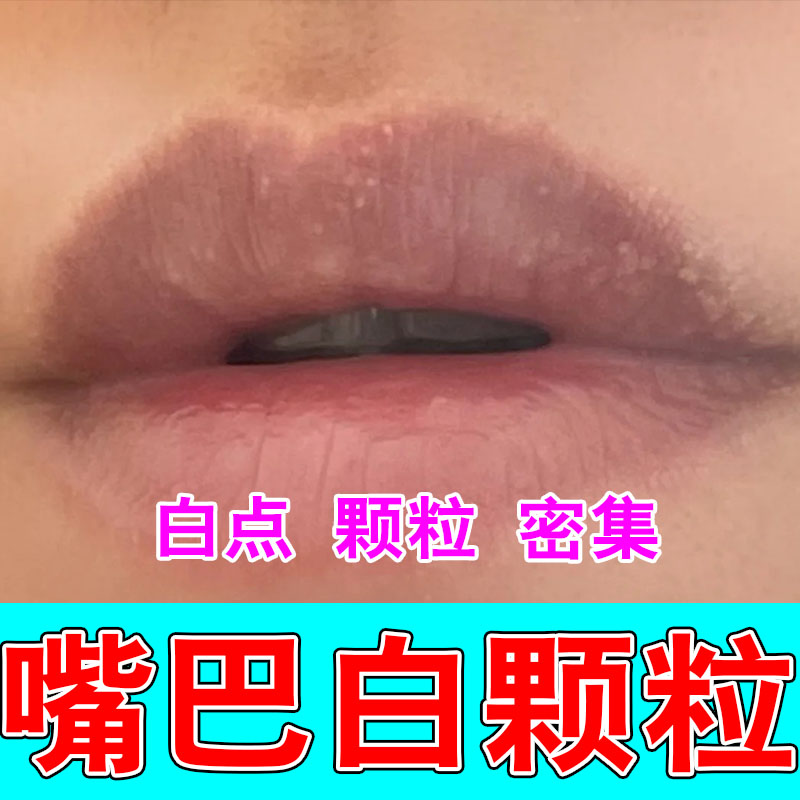 皮脂腺异位膏嘴唇白点脂肪小颗粒增生口角干燥起皮保湿修护软膏