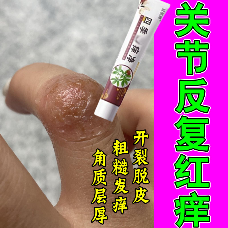 手指关节痒药真菌手指关节长硬疙瘩硬块伤痒粗糙脱皮手痒硬疙瘩膏
