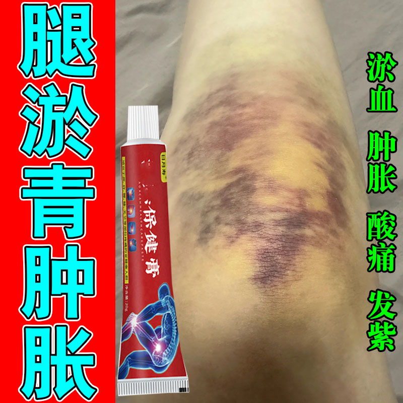 腿上淤青跌打损伤化瘀舒筋消红肿肌肉撞伤发紫拉扭摔伤按摩专用膏