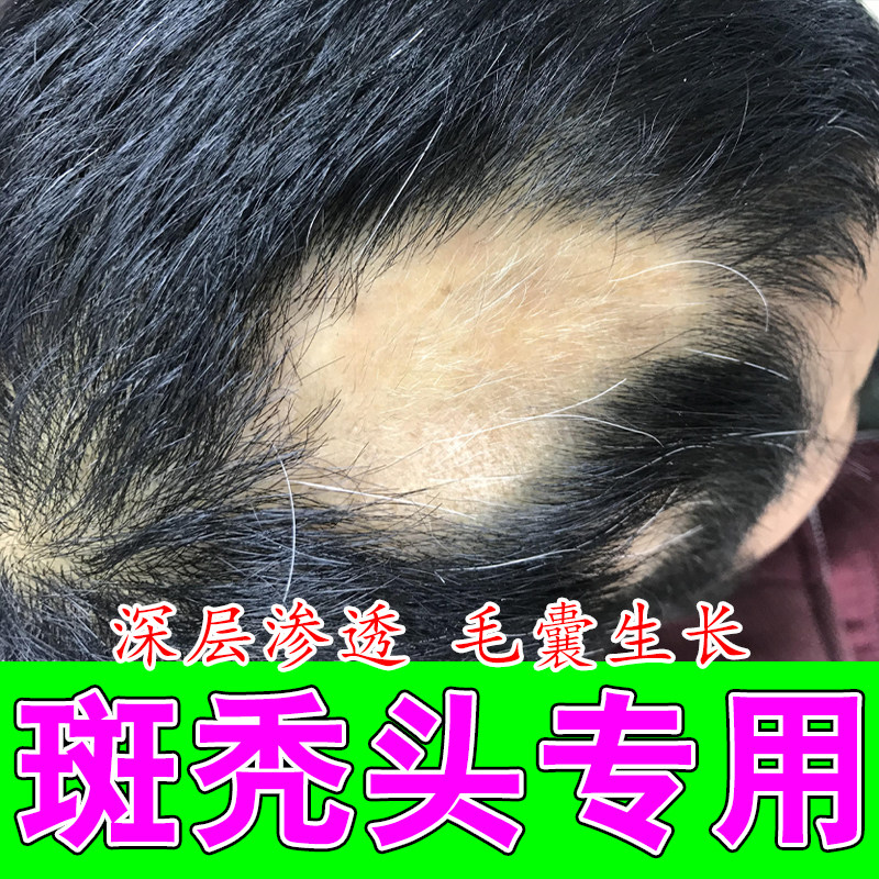 斑秃秃顶毛囊减少头顶大把掉发后脑勺光秃修护育发草本护发喷剂
